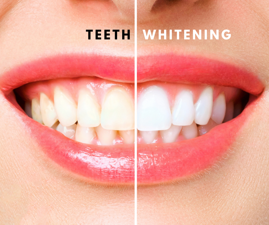 whitening